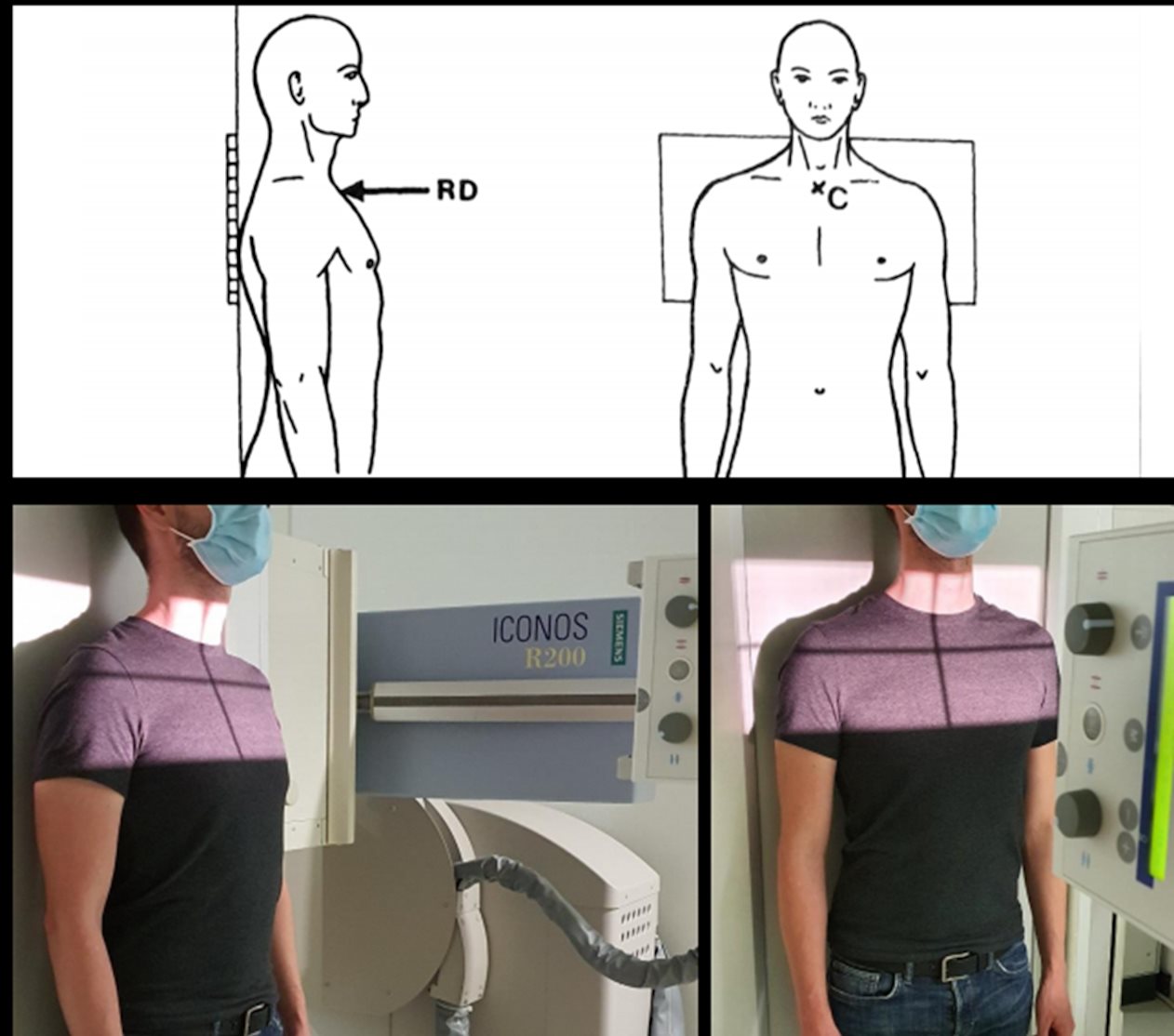 Art. acromio-claviculaire – Face bilatérale