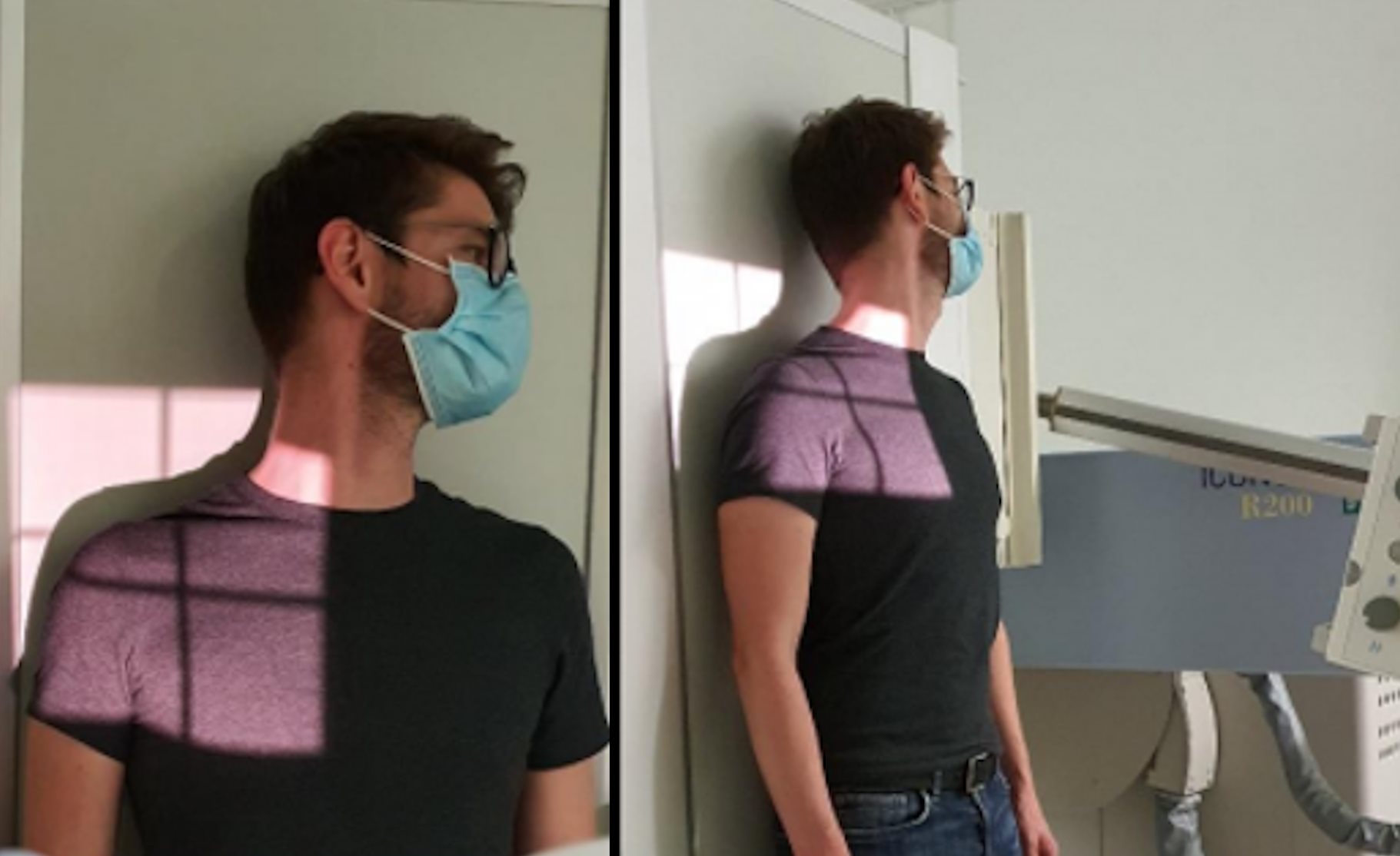 Art. acromio-claviculaire – Face