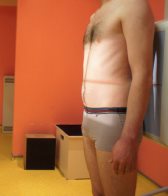 Abdomen sans préparation — Incidence de face