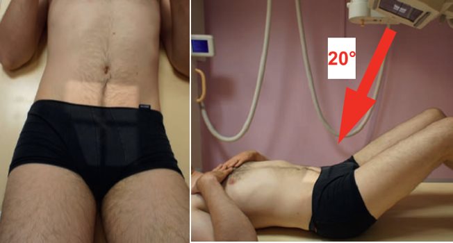 Sacrum — Incidence de face