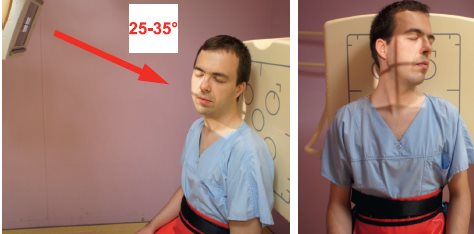 Rachis cervical – Incidence des processus articulaires (Dorland)