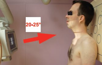Rachis cervical – Incidence de face