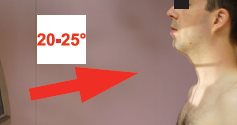 Rachis cervical – Incidence de face