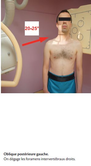 Rachis cervical – Incidence oblique
