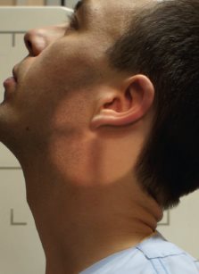 Charnière cervico-occipitale – Incidence dynamique de profil – Extension