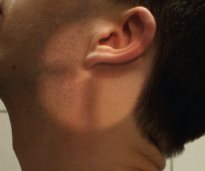 Charnière cervico-occipitale – Incidence dynamique de profil – Extension