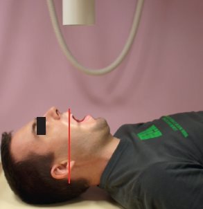 Charnière cervico-occipitale – Incidence de face, bouche ouverte