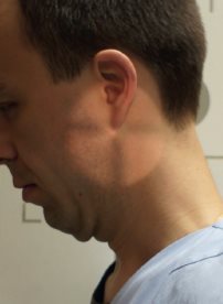 Charnière cervico-occipitale – Incidence dynamique de profil – Flexion