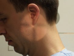 Charnière cervico-occipitale – Incidence dynamique de profil – Flexion