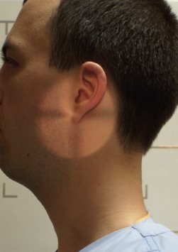 Charnière cervico-occipitale – Incidence de profil – Position neutre