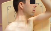 Charnière cervicothoracique – Incidence du nageur