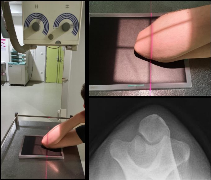Incidence rétro-olécranienne frontale (variante de Laquerrière et Pierquin)