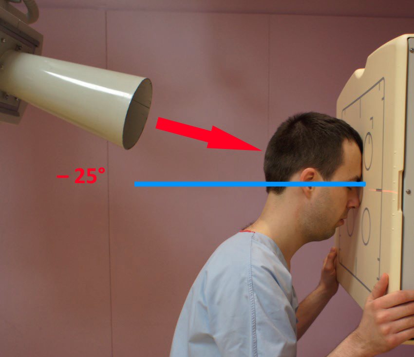 incidence de face