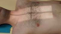 Incidence de face