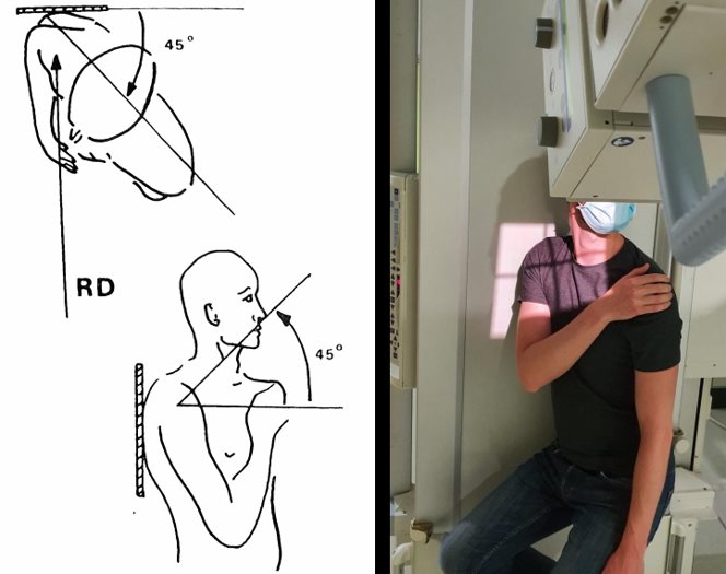 Oblique apical – Incidence de Garth