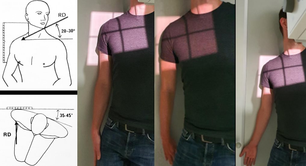 Face rotation neutre / interne / externe