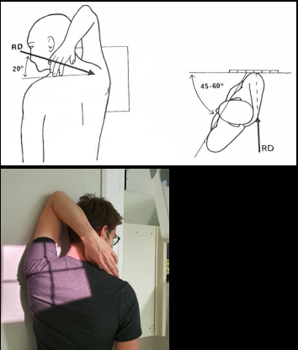 Incidence de Neer (sous-acromiale de profil)