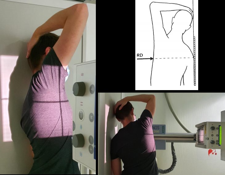 Profil trans-thoracique