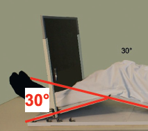 Défilé fémoropatellaire à 30°