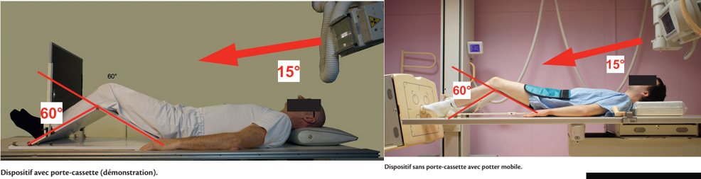 Défilé fémoropatellaire à 60°