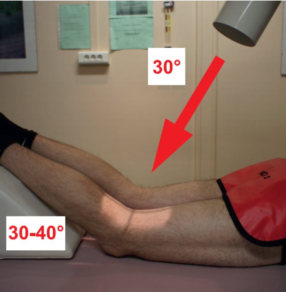 Incidence de l'échancrure intercondylienne