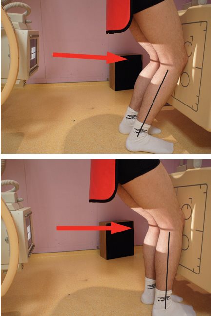 Incidence de face en charge à 30° de flexion (schuss)