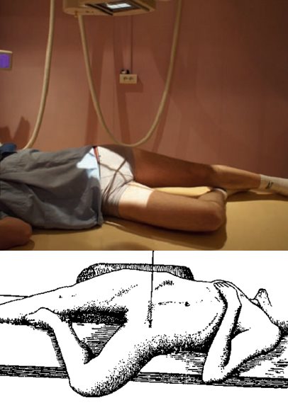 Profil urétral (faux profil)