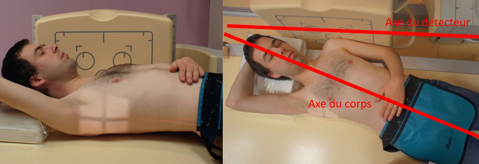 Extrémité supérieure – Incidence transthoracique en décubitus dorsal