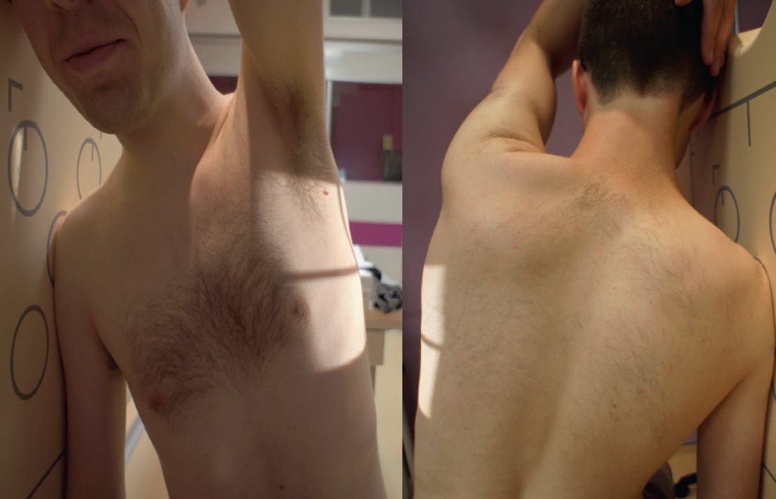 Extrémité supérieure – Incidence transthoracique