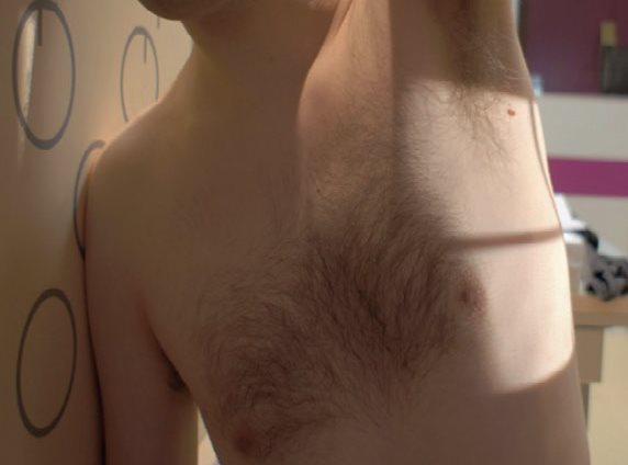 Extrémité supérieure – Incidence transthoracique