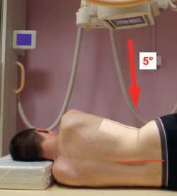 Incidence de profil en décubitus latéral
