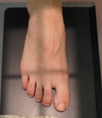 Avant-pied — Incidence de face