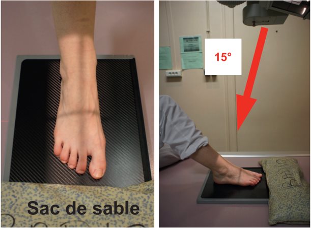 Incidence de face