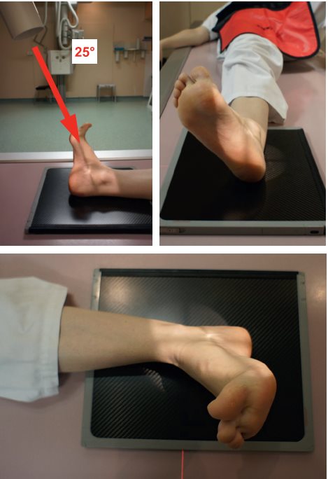 Articulation sous-talienne — Incidence en rotation latérale