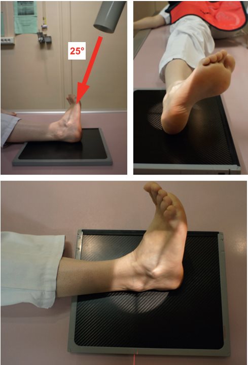 Articulation sous-talienne — Incidence en rotation médiale