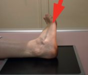 Articulation sous-talienne — Incidence en rotation médiale