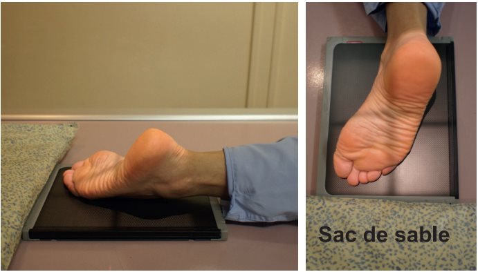 Incidence de l'articulation tarsométatarsienne (Lisfranc)