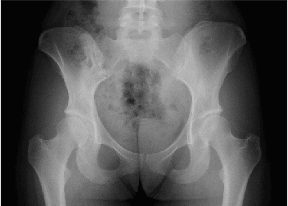 RX