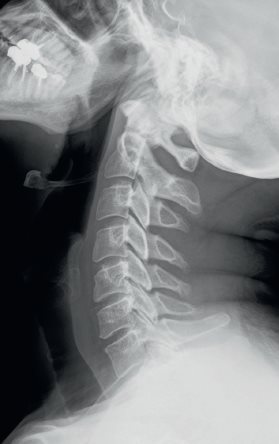 RX