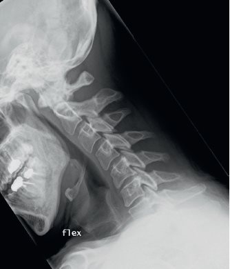 RX