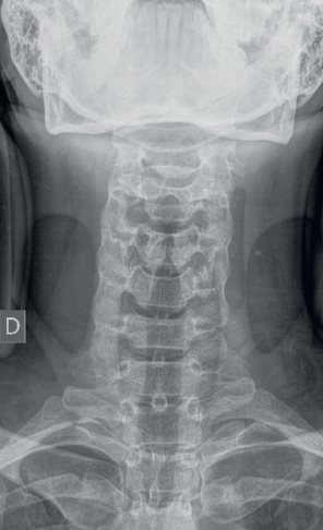 RX