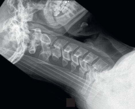 RX
