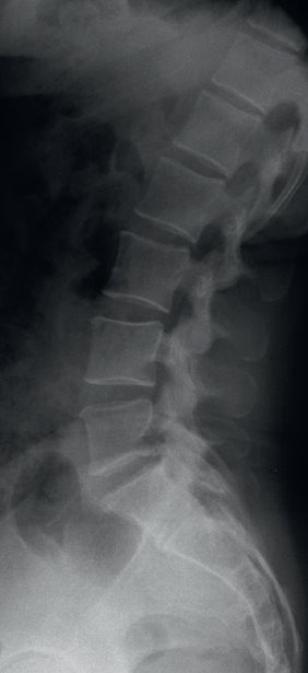 RX
