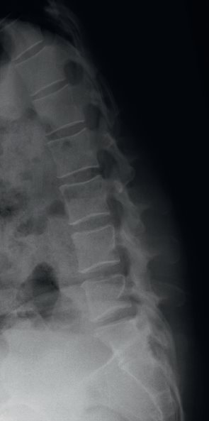 RX