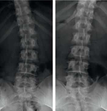 RX