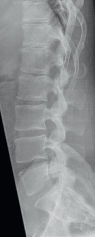 RX