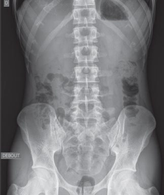 RX