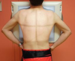 Thorax — Incidence de face